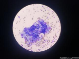 腹水细胞学图6