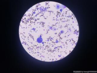 腹水细胞学图5