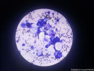 腹水细胞学图7