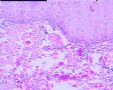 左髂嵴皮肤新生物图1