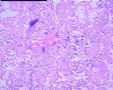 左髂嵴皮肤新生物图5