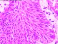 左乳外侧缘皮下结节图15