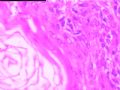左乳外侧缘皮下结节图16