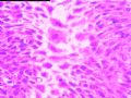 左乳外侧缘皮下结节图17
