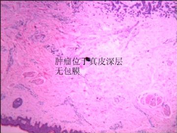 右手臂肿块图1