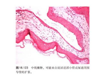 经典病例学习-阴茎中缝囊肿图14