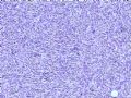 欣赏--腹壁肿瘤图5